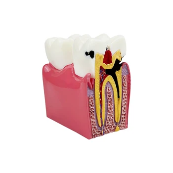 6 Kez Diş Diş Modeli Çürük Karşılaştırma Modelleri Çalışma Protez Öğretim Anatomi Eğitim Diş Modeli Diş Çalışma