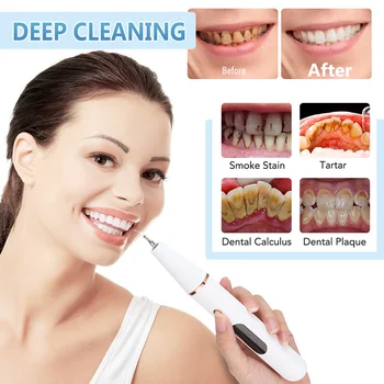 Akıllı Diş Temizleme Diş Sonoshine Diş Temizleyici Profesyonel Temizleyici Diş Ultrasonik Diş Temizleme Calculus Remover